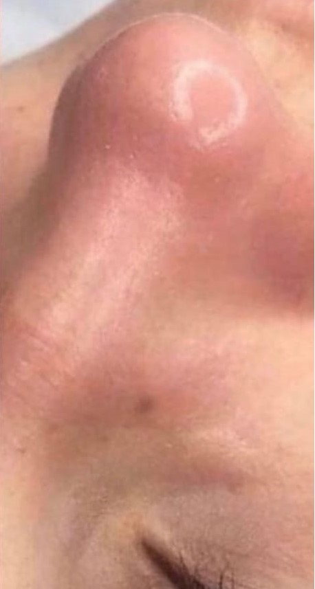 faciall-after
